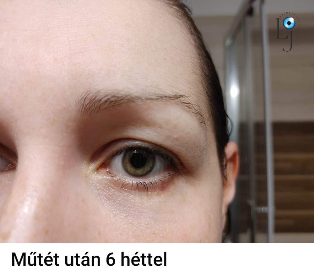 Szemhéjplasztika előtte-utána 4